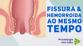 Dá pra ter hemorroida e fissura ao mesmo tempo?! 😬