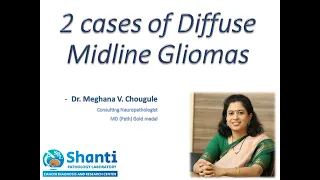 Diffuse midline glioma