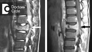 Can disc regenerate after Spinal Tuberculosis? - Dr. Mohan M R