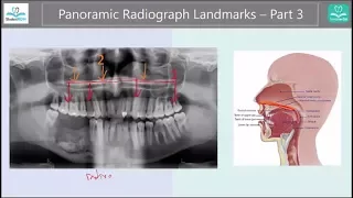 [Simple] Panoramic Radiograph Landmarks - Part 3, condyle etc.