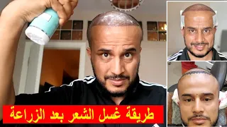 زراعة الشعر وطريقة الغسل والاعتناء بالشعر بعد الزراعة