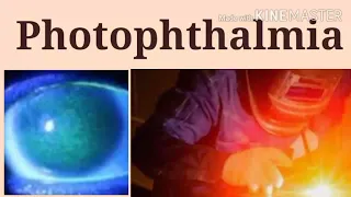 Photophthalmia | photophthalmia treatment | photokeratitis | photokeratitis symptoms | uv keratitis