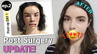 Post Surgery Update|Corner Lip Lift, Undereye Fat Repositioning, Phitrum Reduction,and more!| Result