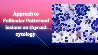 Approach to Follicular Patterned lesions of Thyroid on Cytology