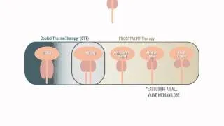 Urologix Prostiva and Cooled ThermoTherapy Patient Selection Overview