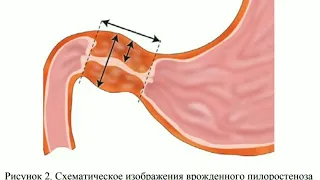 Пилоростеноз  у детей клиника, диагностика, лечение.