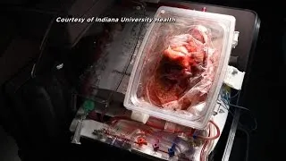 ‘Heart-In-Box’ Transplant Breakthrough