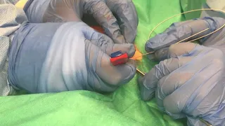 Indwelling Pleural Catheter (IPC) insertion (Dissection-free)
