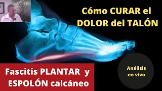 CÓMO CURAR EL DOLOR DEL TALÓN causado por FASCITIS PLANTAR y ESPOLÓN CALCÁNEO