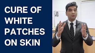 How To Cure Vitiligo? Incl. Home remedies to Reduce White Patches on Skin