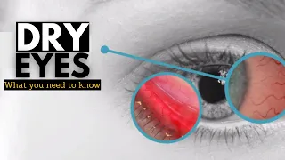 Dry Eye Syndrome, Causes, Signs and Symptoms, Diagnosis and Treatment.