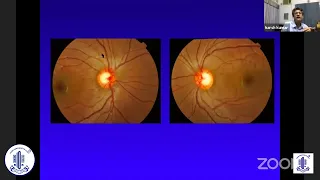 Optic Disc Assessment Make your Cup of Tea - Dr Harsh Kumar