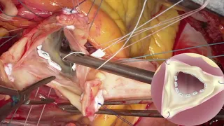 Repair of Type A Aortic Dissection