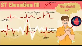 ST elevation myocardial infarction -STEMI | ST elevation MI pathophysiology, ECG finding and example