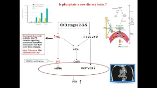 Mineral Bone Disorder in CKD