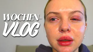 WOCHEN VLOG: Ich habe ein Ei am Auge 😳😩 | YungStachel