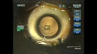 Bari's Shell Technique Phaco: Soft cataract