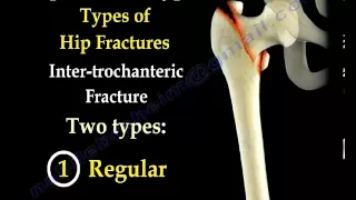 Hip Fractures, Types  and fixation - Everything You Need To Know - Dr. Nabil Ebraheim