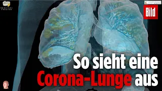 3D-Bilder zeigen jetzt eine durch COVID-19 zerstörte Lunge | Corona
