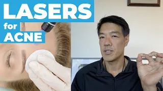 Acne Treatments with Lasers | Dr Davin Lim