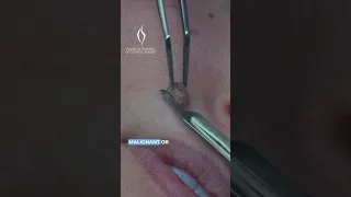 SCARLESS MOLE REMOVAL💫 American Academy of Cosmetic Surgery -AACS