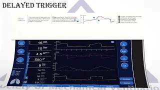 Patient Ventilator Dysynchronies - Part 1 Trigger Dyssynchronies