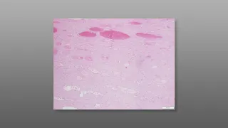 Fine Needle Aspiration Biopsy (FNA) Techniques - Sampling Highly Vascular Targets