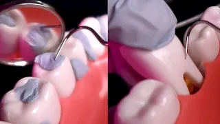 ASMR🦷 1 Hour of Teeth Scaling ⎢ Deep Dental Cleaning  ⎢ Dental Pick (No Talking)