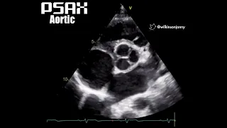 Parasternal Short Axis aortic level (PSAX Aortic)