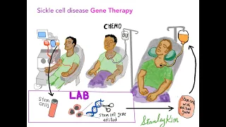 Sickle Cell Disease: Past, Present, Future, and Gene therapy