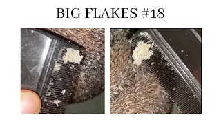 Dandruff combing#18 BIG FLAKES