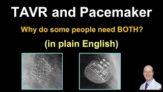 TAVR and Pacemaker - May I Need Both? (In Plain English)