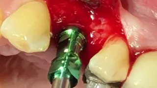 Osseodensification versah bures & implant placement