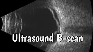 Ultrasound B-scan #optometry #eye