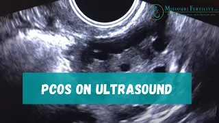 PCOS: Sonogram and Discussion