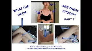 WHAT ARE THESE SPOTS? -- IMMUNOTHERAPY NIVOLUMAB RASH? PART 3