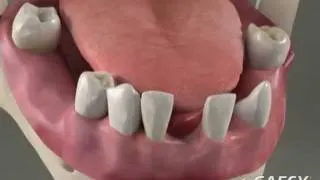 Dentures Overdentures - Roseville Dentist