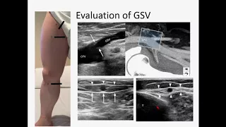 Ultrasound Evaluation of Lower Limb Superficial Veins - Subasit Acharji, MD