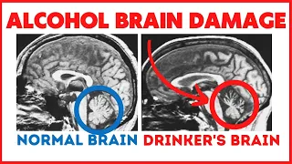 11 Ways Alcohol Induces Brain Damage - Often Irreversible!