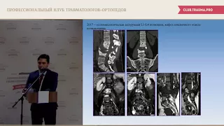 Ревизионное хирургическое лечение переломов грудного и поясничного отделов позвоночника