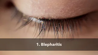 1. Blepharitis