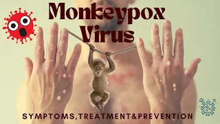 Monkeypox Virus outbreak, symptoms, treatment, prevention, transmission |breaking news