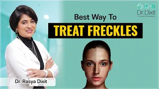 FREQUENTLY ASKED QUESTIONS ABOUT FRECKLES: HOW TO GET RID OF THEM?