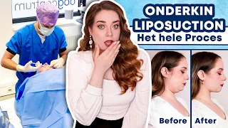 ONDERKIN LIPOSUCTIE 💉 BELANGRIJKE INFO, INGREEP, HELING, BEFORE & AFTER 🏥 ALLES IN 1 VIDEO !!