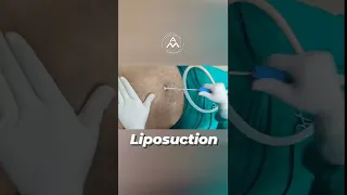 Liposuction Surgery In Delhi | #Shorts | #YouTubeShorts | #VideoShorts | Dr. Mrinalini Sharma