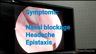 Nasal Septal Spur | ENT