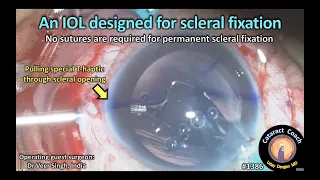 CataractCoach 1386: IOL designed for scleral fixation