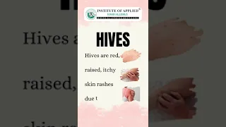 How to Treat Hives (Urticaria) Naturally? #shorts