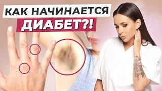 Как начинается САХАРНЫЙ ДИАБЕТ? / К чему приводит диабет?