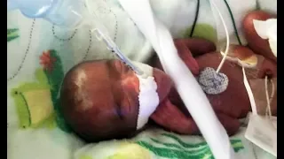 San Diego Hospital Reveals World's Tiniest Baby